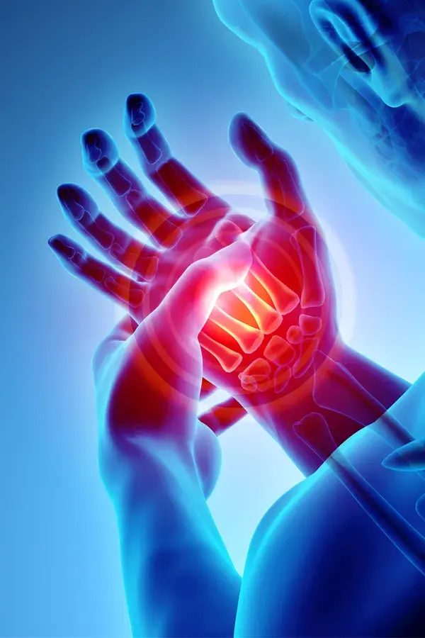 Carpal-Tunnel-Syndrome-Treatment 3D illustration of a human hand highlighted with pain. Get treatment for carpal tunnel syndrome from Stephen Beyer, DC in Mokena.
