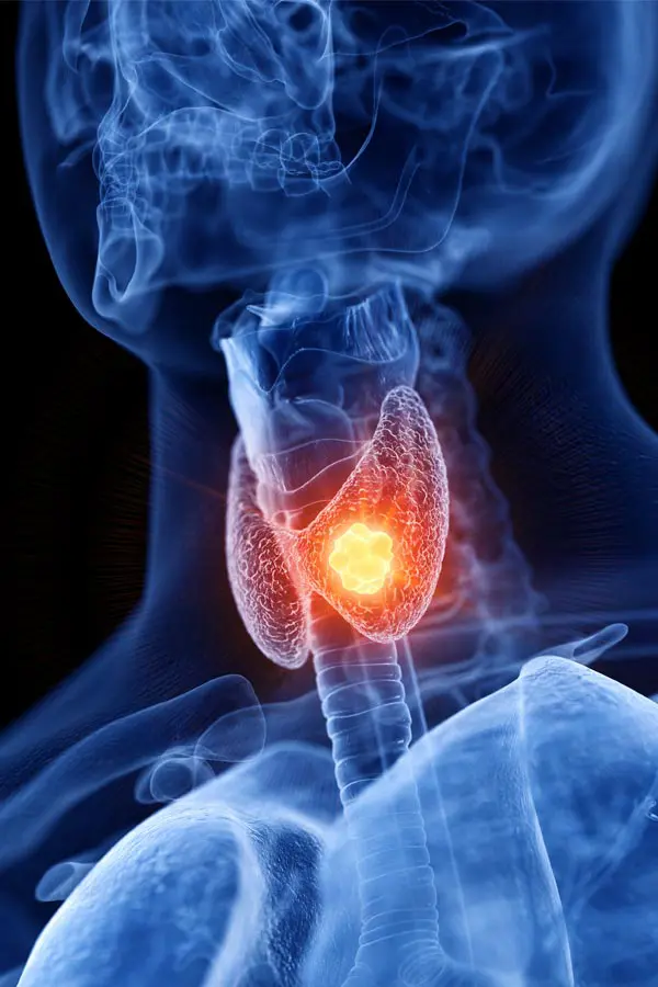 Thyroid-Imbalance-Treatment A 3D illustration of an x-ray of a human neck, highlighting the thyroid. Get help with thyroid imbalance from Stephen Beyer, DC in Mokena.