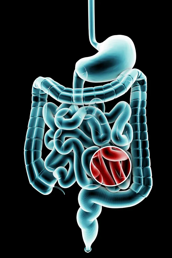 Ulcerative-Colitis-Treatment 3D illustration of the digestive system in blue tones, with an area of discomfort in red tones. Get treatment for Ulcerative Colitis from Stephen Beyer, DC in Mokena.
